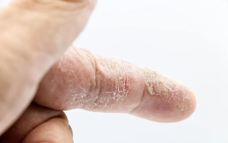 Detailed close-up of a human finger with dry and calloused skin showcasing texture and skin condition.