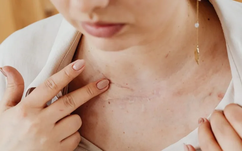 A woman gently applying concealer on a chest scar with manicured nails.